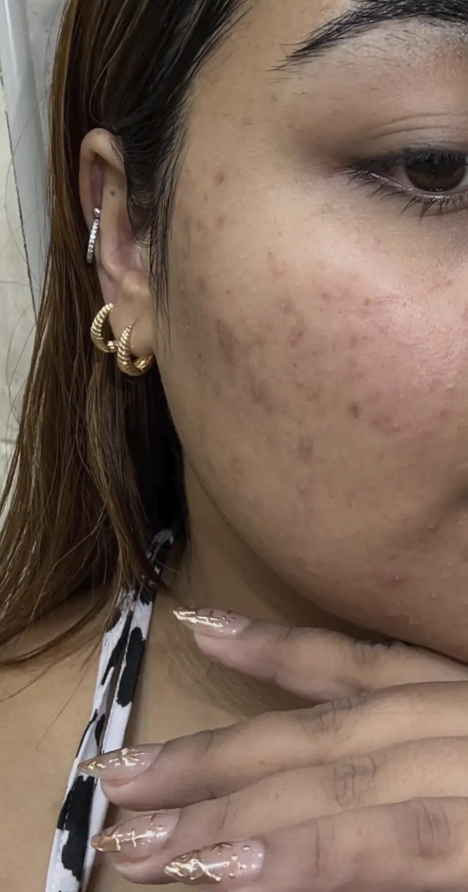 benzoyl peroxide for hormonal breakouts