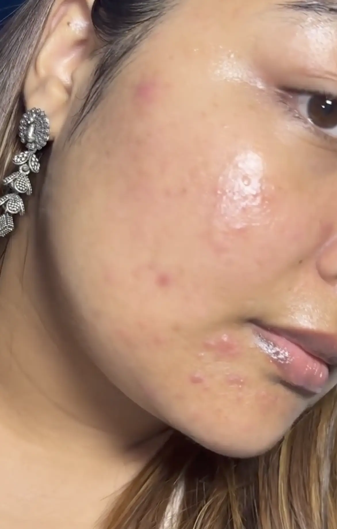 best over the counter treatment for hormonal acne