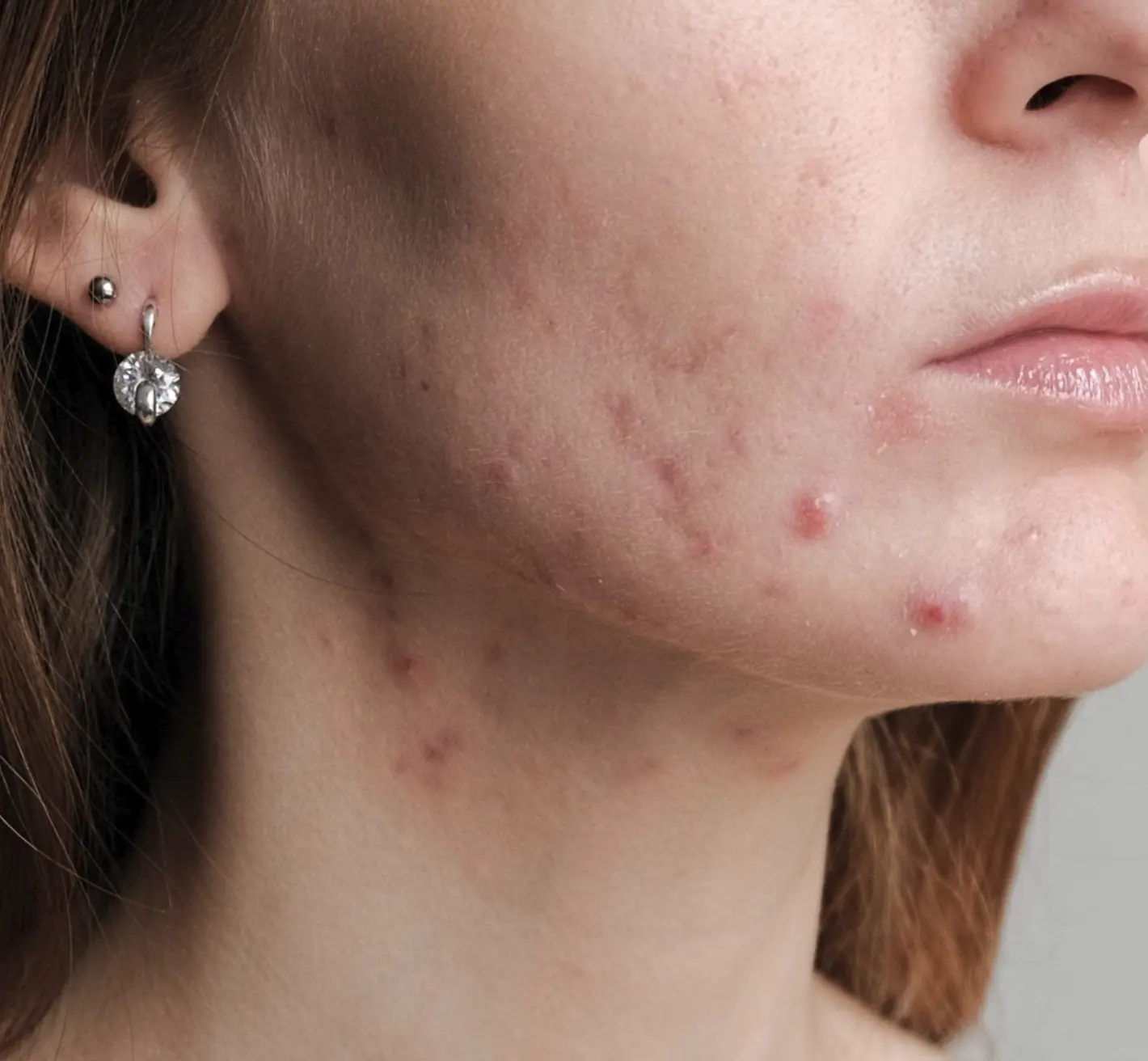 how to treat hormonal acne with over the counter products