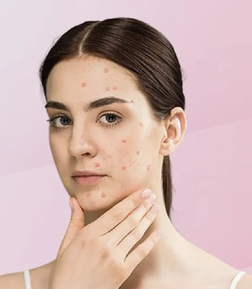 niacinamide for hormonal acne inflammation