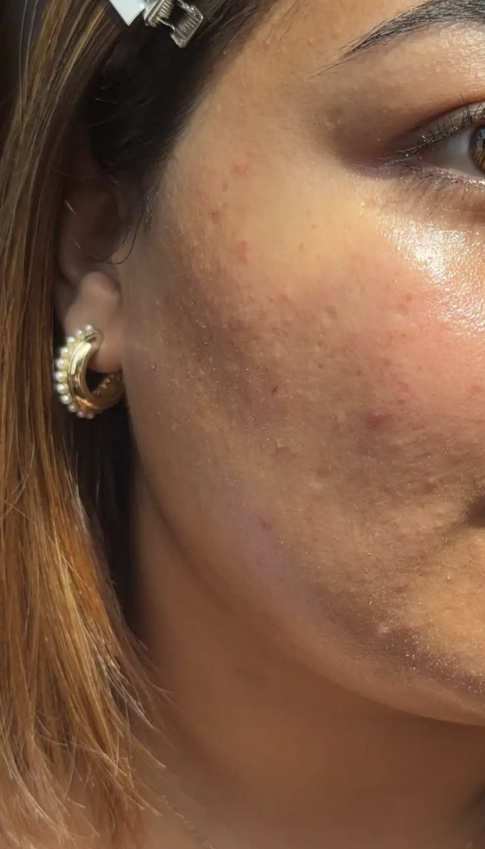 salicylic acid for hormonal acne routine